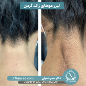 لیزر موهای زائد گردن در شیراز