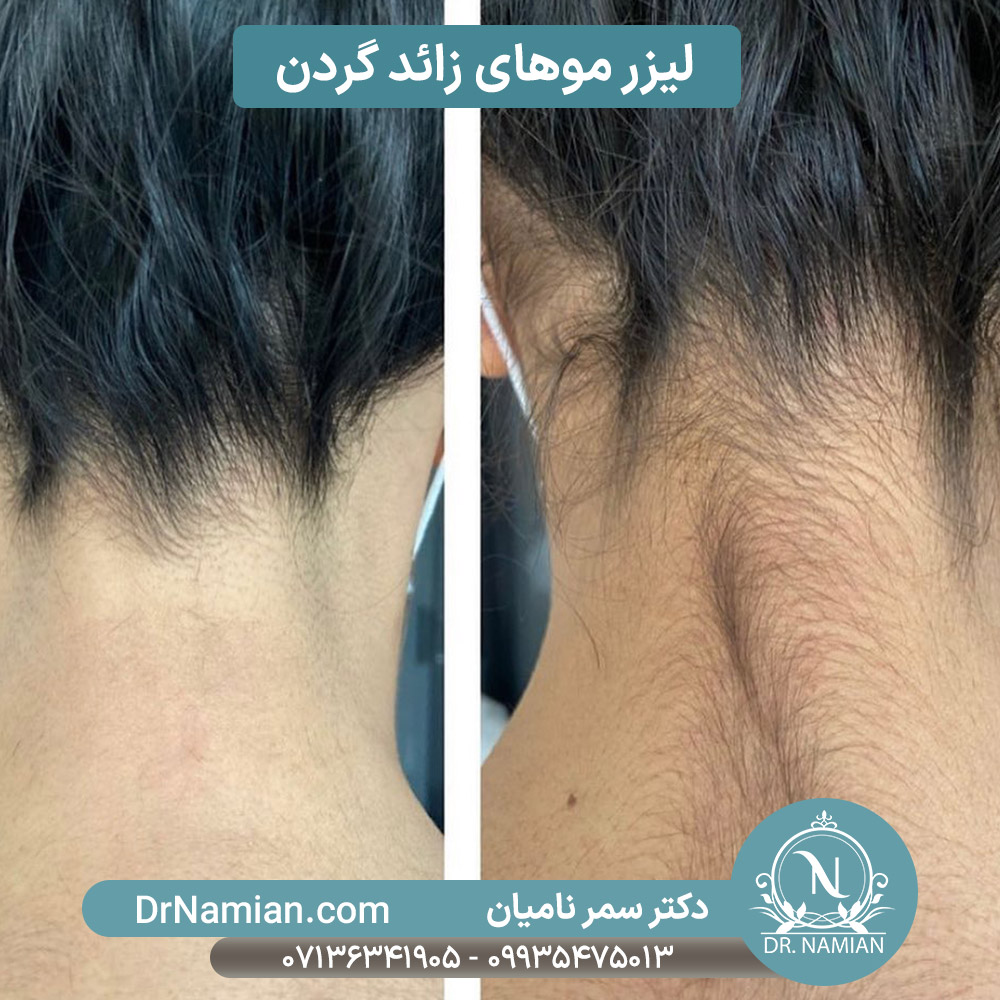 لیزر موهای زائد گردن در شیراز