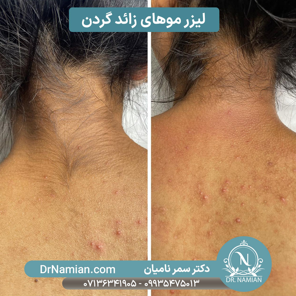 عکس قبل و بعد لیزر موهای زائد گردن شیراز عکس قبل و بعد لیزر موهای زائد گردن شیراز