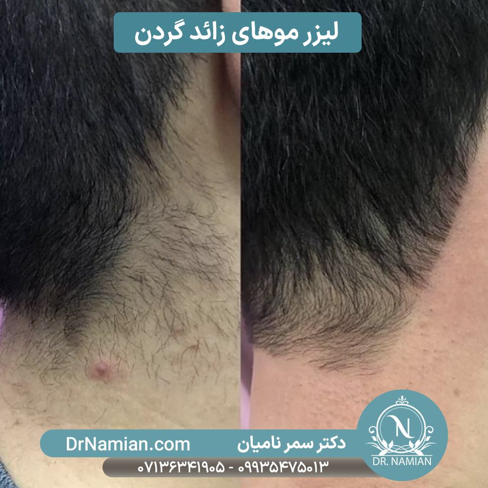 لیزر موهای زائد گردن آقایان در شیراز لیزر موهای زائد گردن آقایان در شیراز