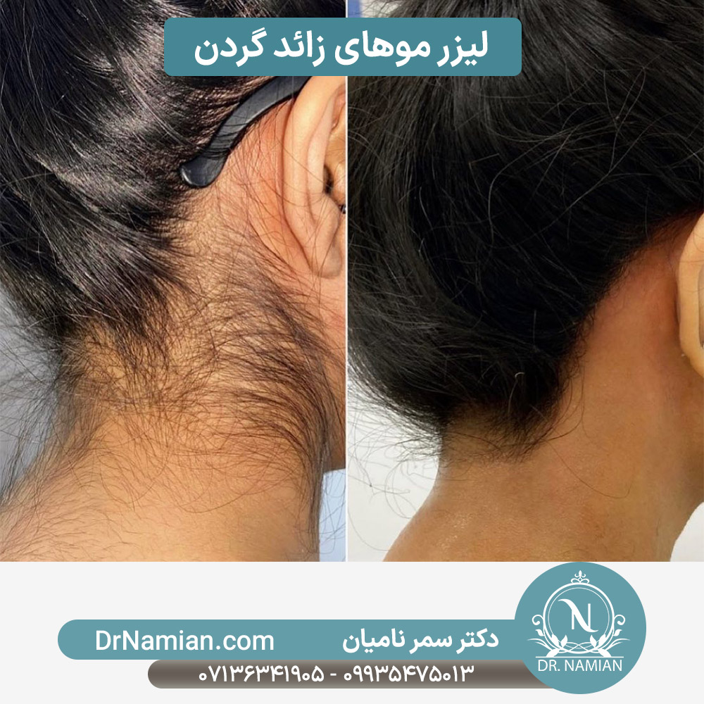نتیجه لیزر موهای زائد گردن شیراز نتیجه لیزر موهای زائد گردن شیراز