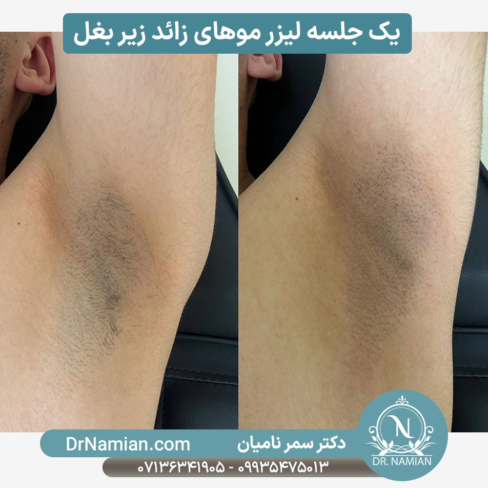 نتیجه یک جلسه لیزر موهای زائد زیربغل