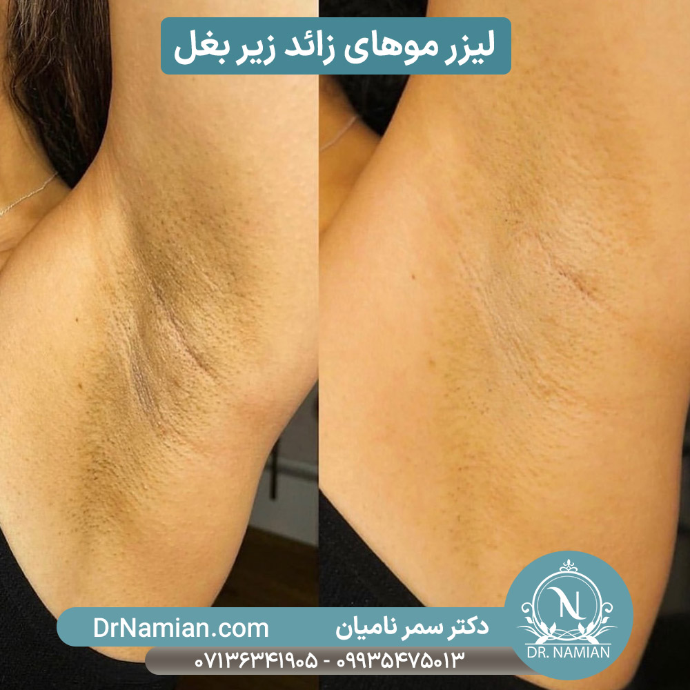 لیزر موهای زائد زیر بغل در شیراز