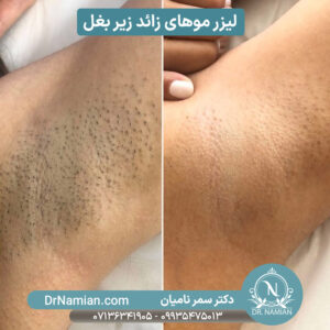 لیزر موهای زائد زیر بغل در شیراز