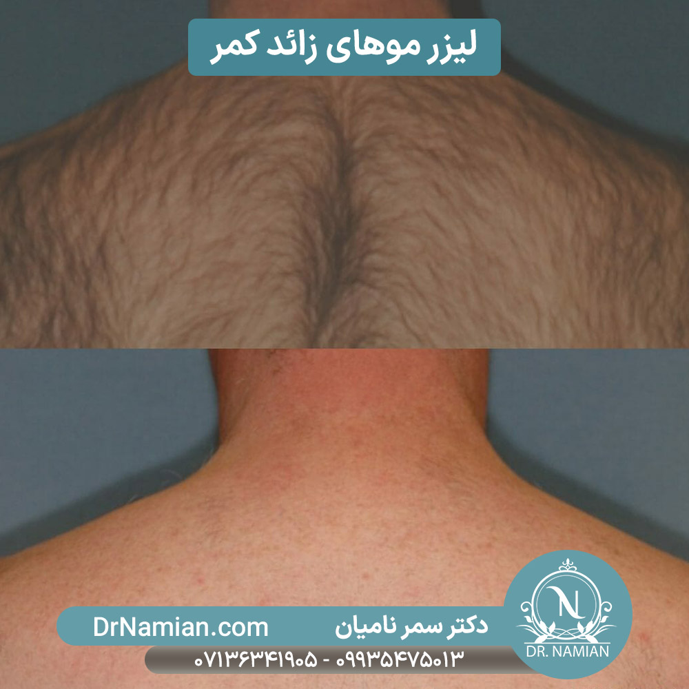 لیزر موهای زائد کمر شیراز لیزر موهای زائد کمر شیراز