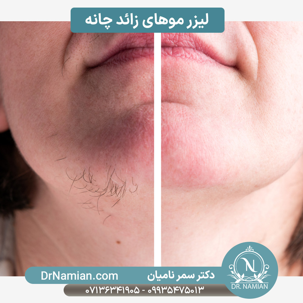 لیزر موهای زائد چانه