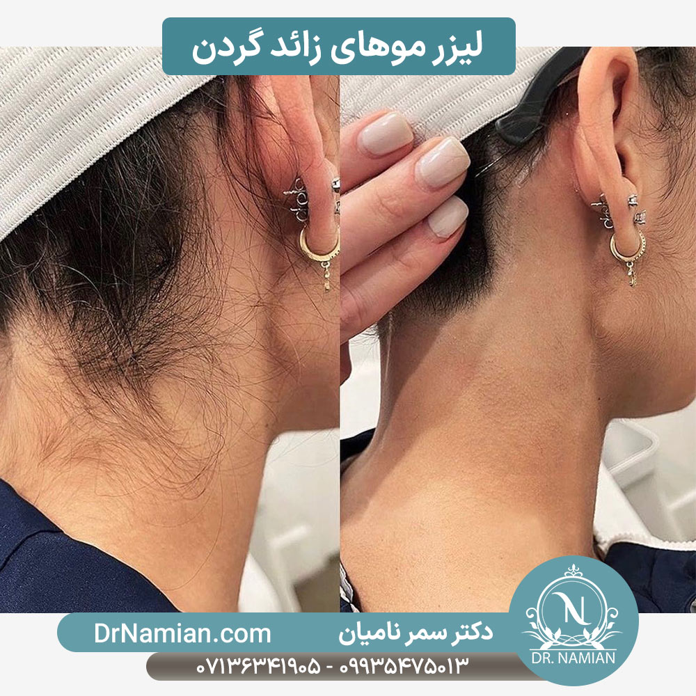لیزر موهای زائد گردن در شیراز لیزر موهای زائد گردن در شیراز