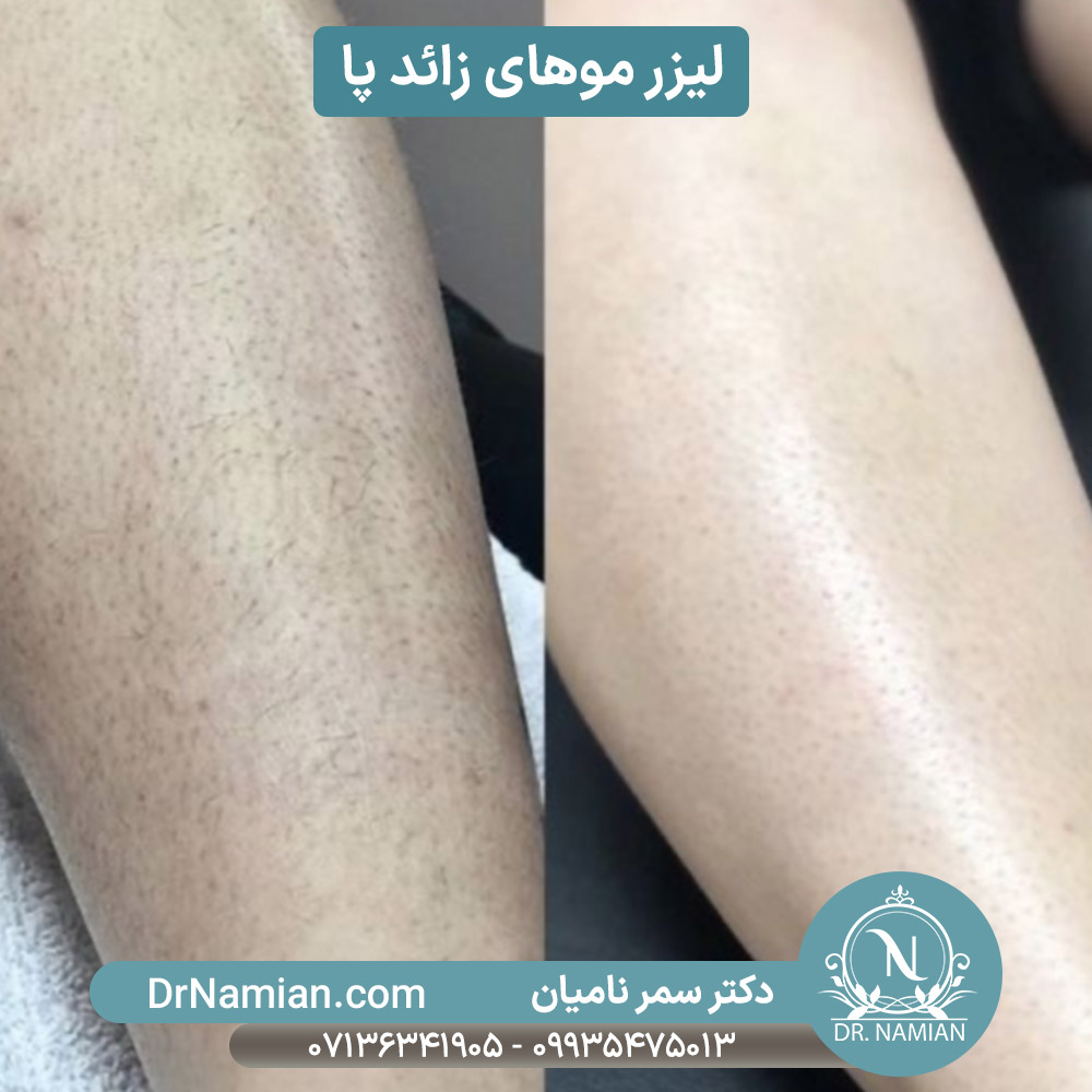 لیزر موهای زائد پا در شیراز لیزر موهای زائد پا در شیراز