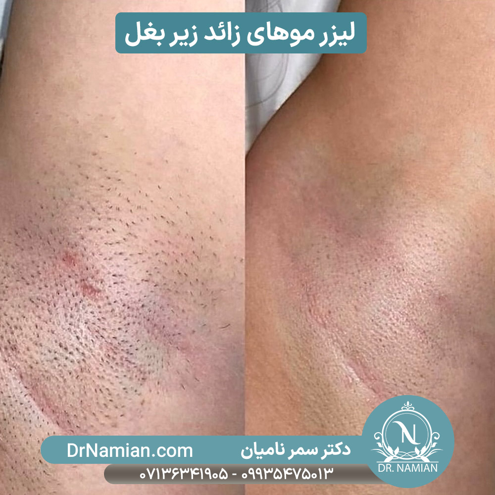 نتیجه لیزر مو زائد زیربغل