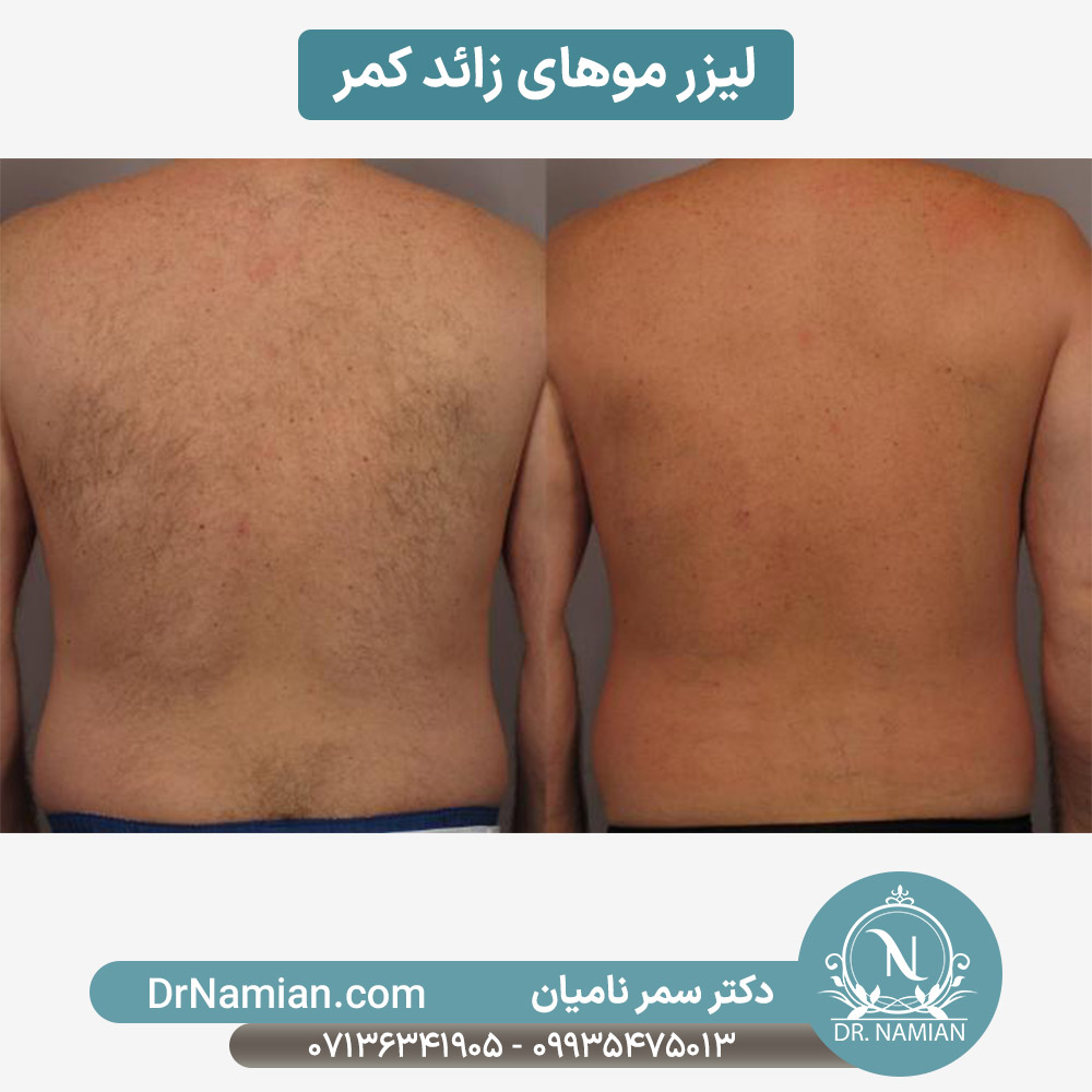 لیزر موهای زائد کمر آقایان در شیراز لیزر موهای زائد کمر آقایان در شیراز