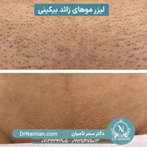 لیزر موهای زائد بیکینی در شیراز