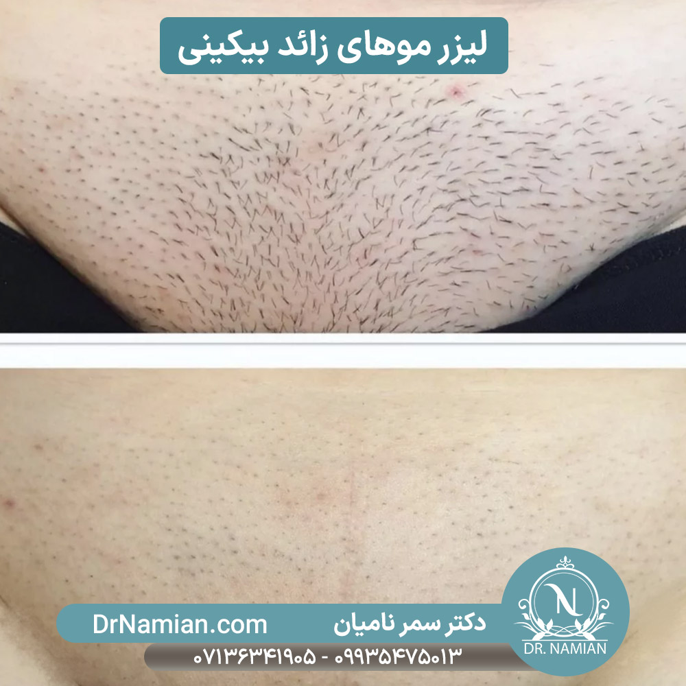 مرکز لیزر موهای زائد بیکینی معالی آباد شیراز مرکز لیزر موهای زائد بیکینی معالی آباد شیراز