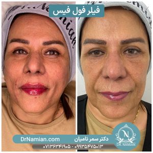 فیلر فول فیس شیراز