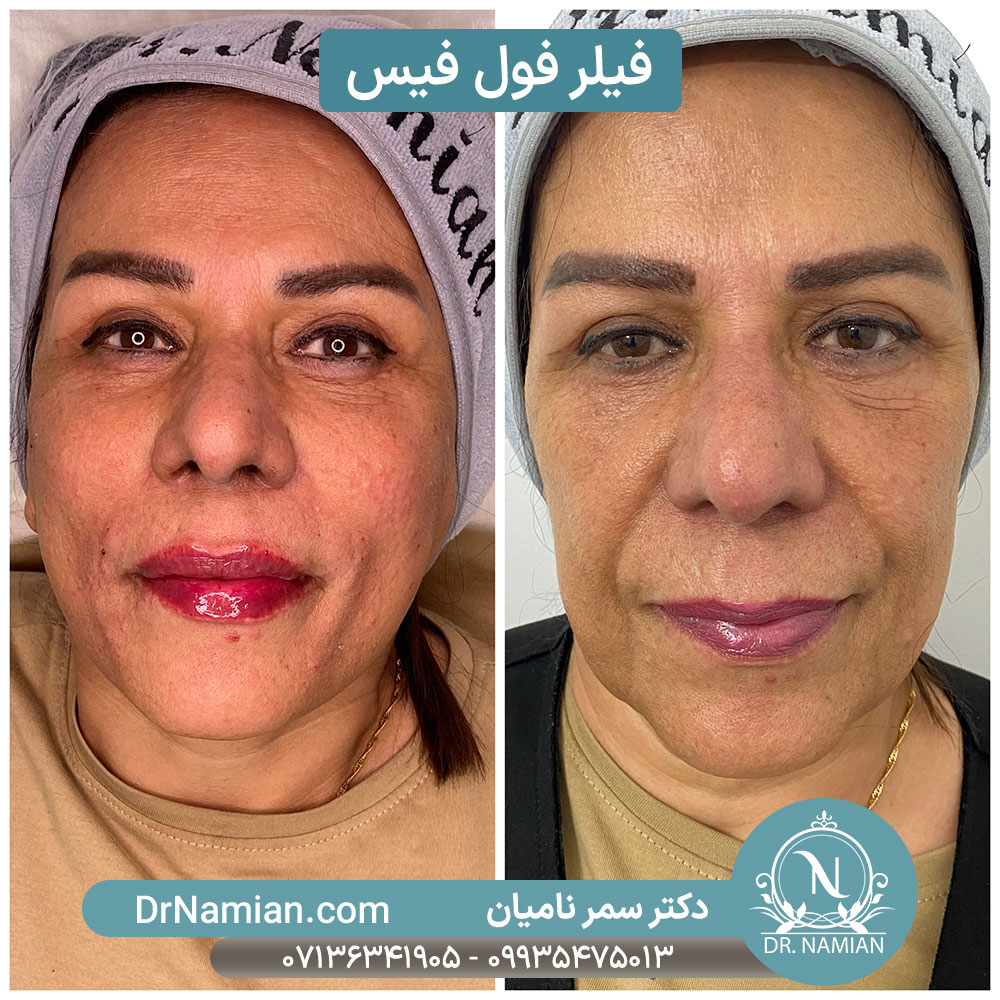فیلر فول فیس برای جوانسازی صورت