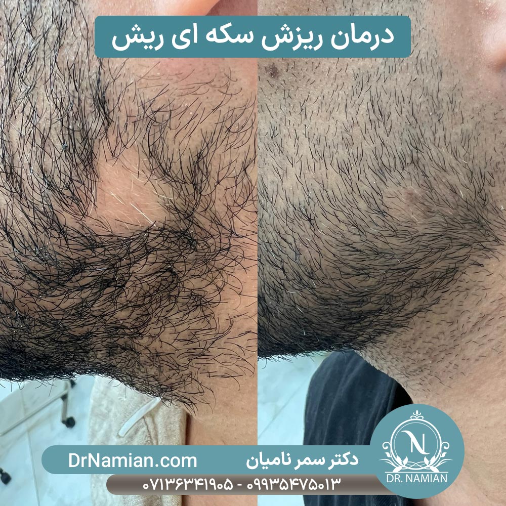 قبل و بعد درمان ریزش سکه ای ریش قبل و بعد درمان ریزش سکه ای ریش