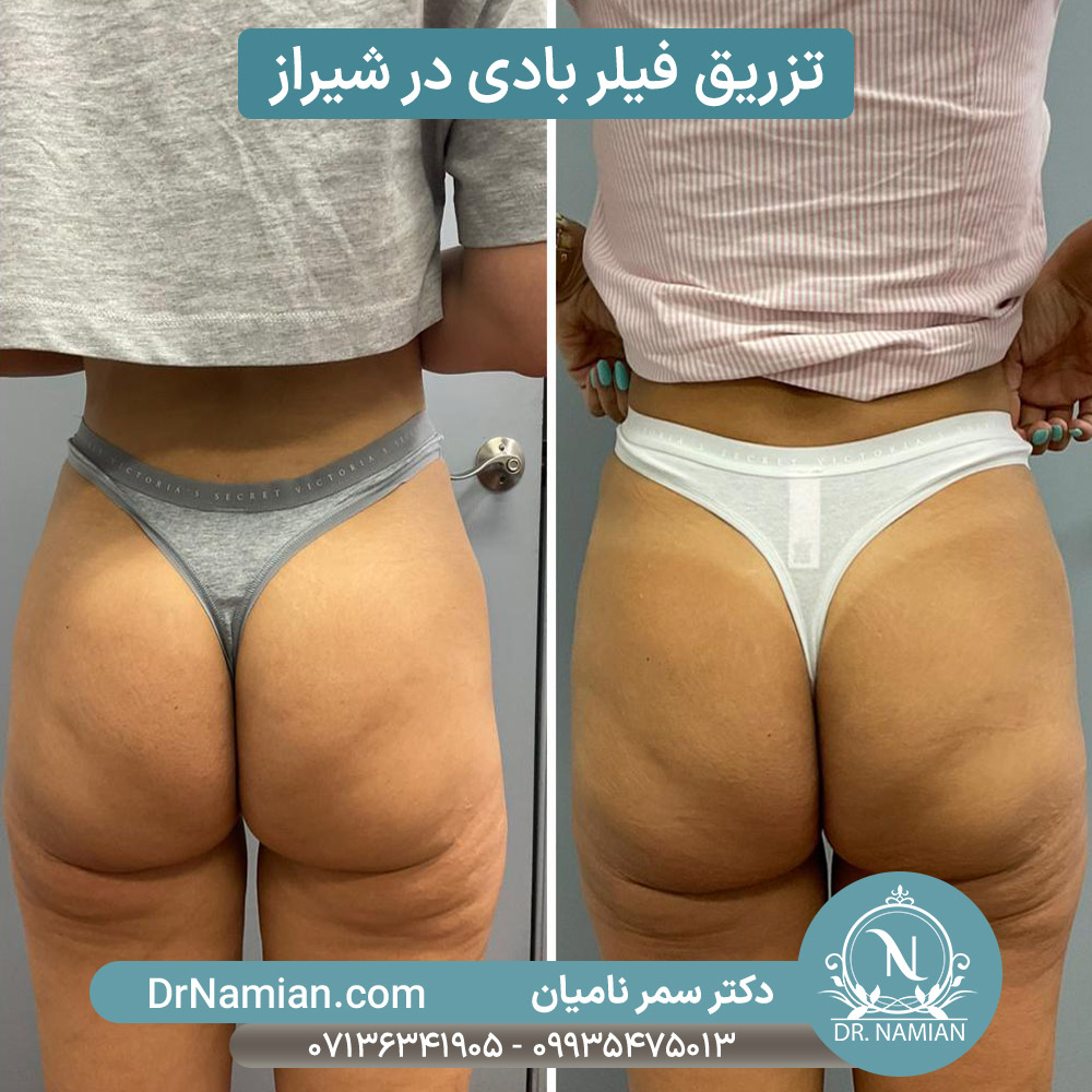 فیلر باسن در تزریق فیلر بادی فیلر باسن در تزریق فیلر بادی