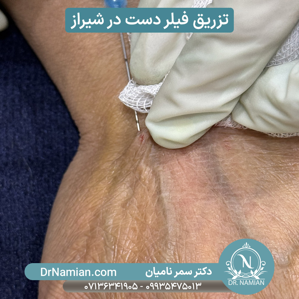 فیلر پشت دست در تزریق فیلر بادی فیلر پشت دست در تزریق فیلر بادی