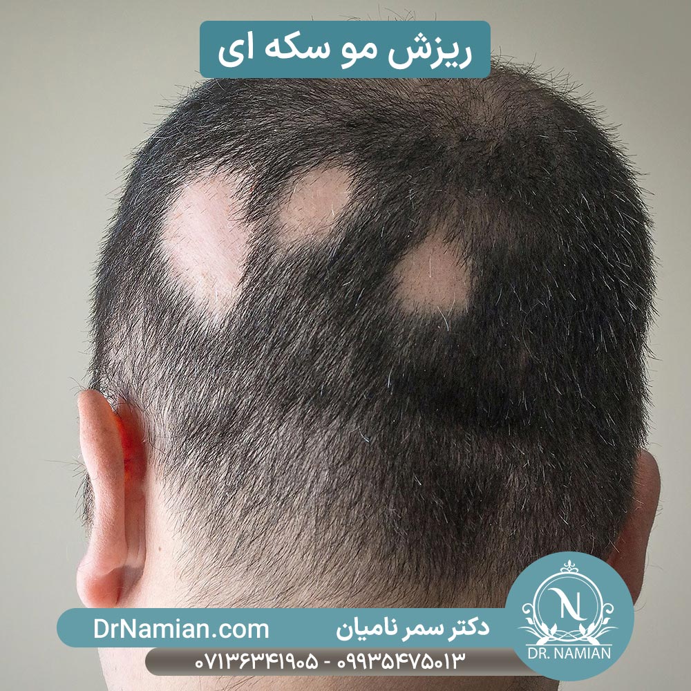 ریزش سکه ای مو