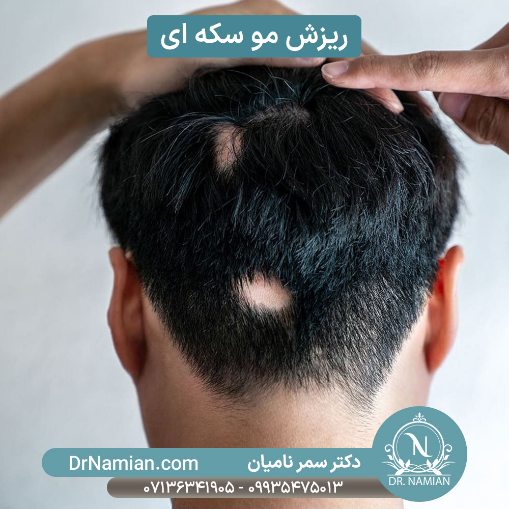 ریزش موی سکه ای در مردان