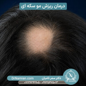 درمان ریزش مو سکه ای در شیراز درمان ریزش مو سکه ای در شیراز