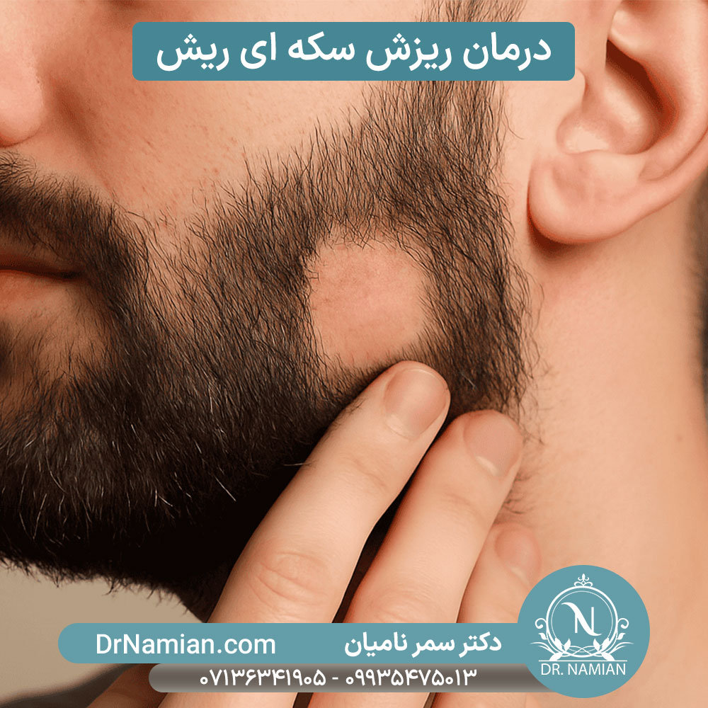 ریزش ریش سکه ای ریزش ریش سکه ای